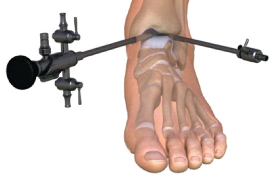 Ankle Arthroscopy Surgery